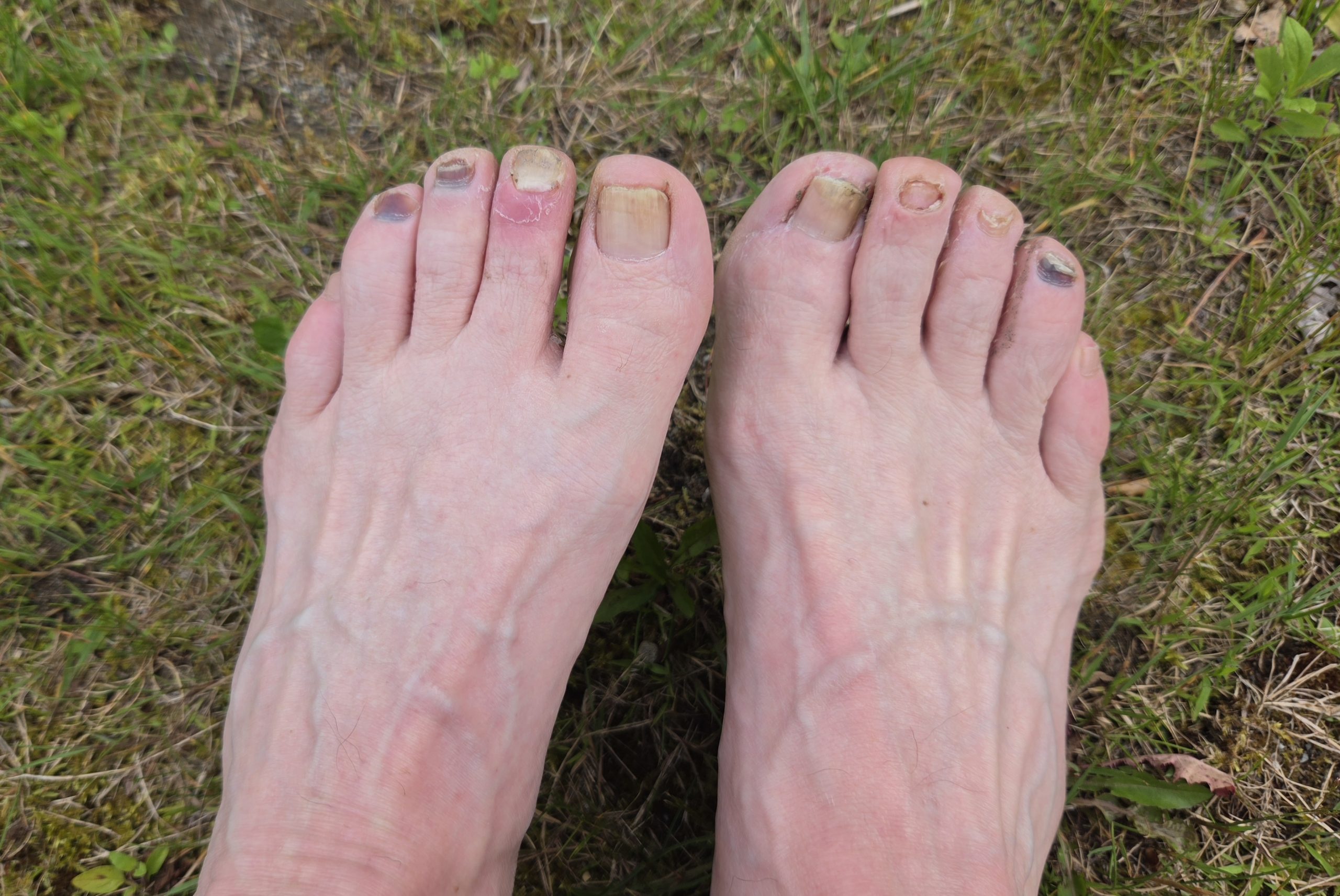 Two feet with visible damage: missing and loose toenails, dark discoloration, raw spots, and peeling skin on bare grass ground.